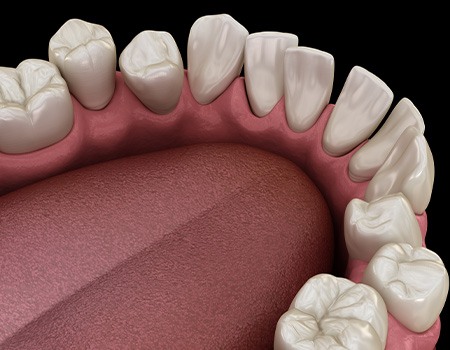 Illustration of gapped teeth