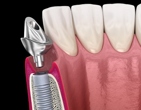 A 3D illustration of a placed dental implant and its abutment