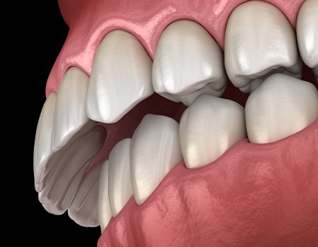 Illustration of overbite