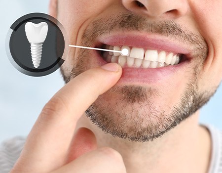 A photo highlighting a man’s completed dental implant