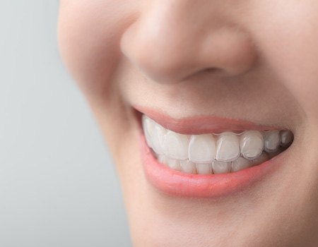 Invisalign aligners are much more comfortable than traditional braces