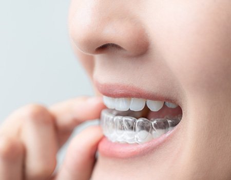 Invisalign aligners are so discreet that they’re nearly undetectable