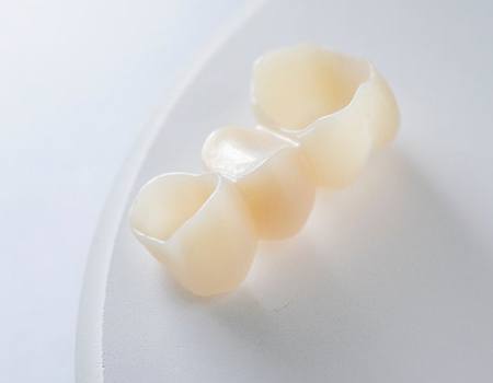 Underside of a dental bridge