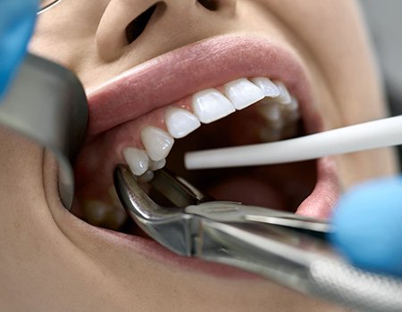 A woman having her tooth extracted with dental forceps