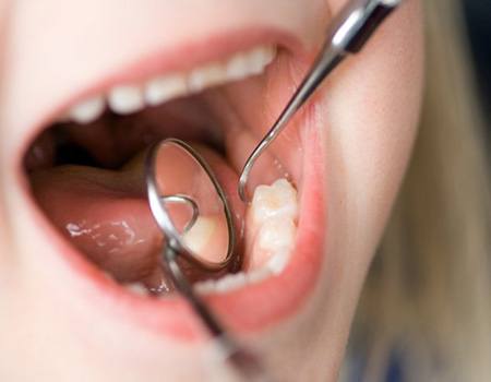 a patient opening their mouth during a dental checkup