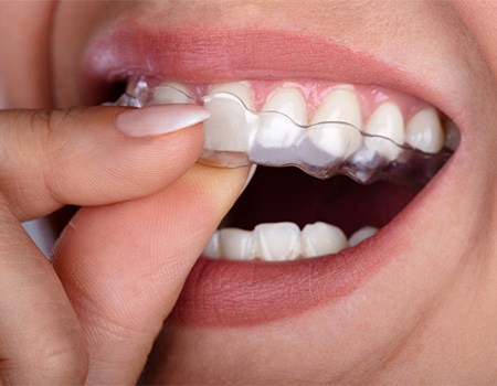 Closeup of patient putting on clear aligner